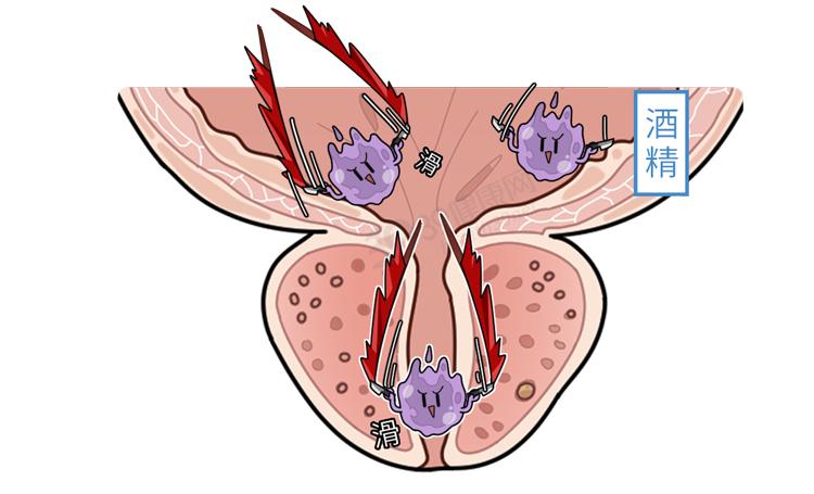 什么是前列腺钙化的相关图片